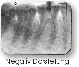 Rntgenbild in Negativ-Darstellung